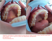 Под анестезией были сняты пломбы с пятого и шестого зубов и реставрированы одновременно.
